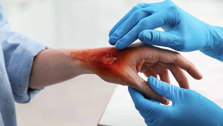 علاج الحروق