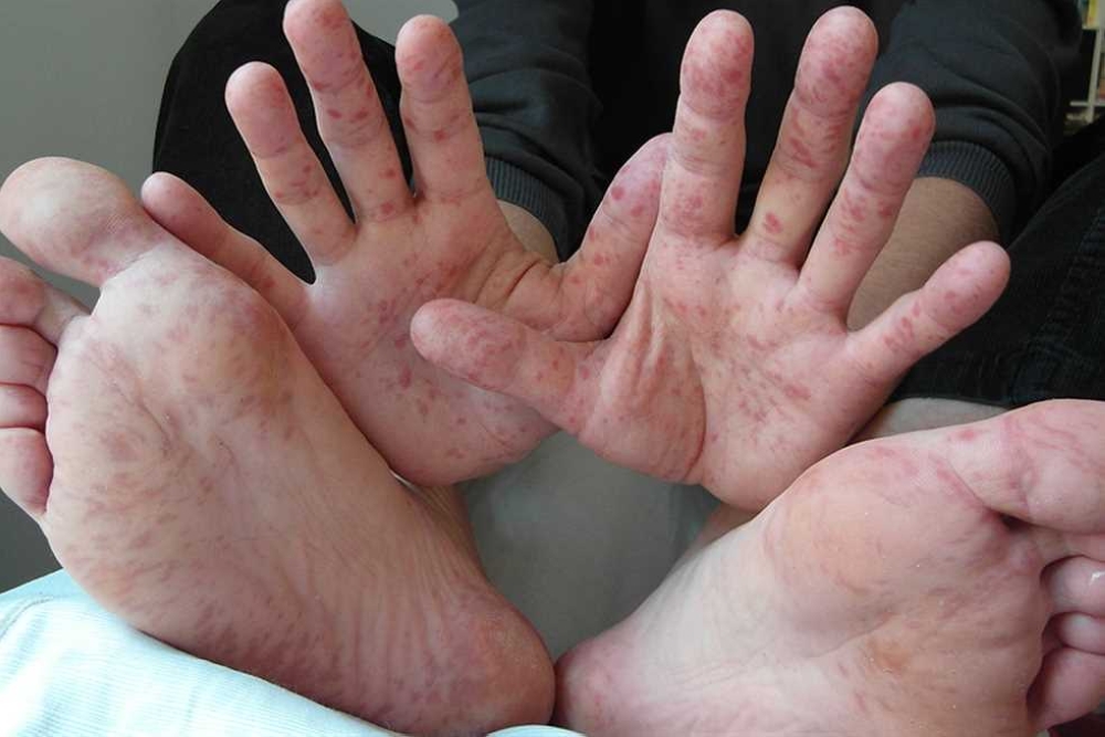 فيروس اليد والقدم والفم