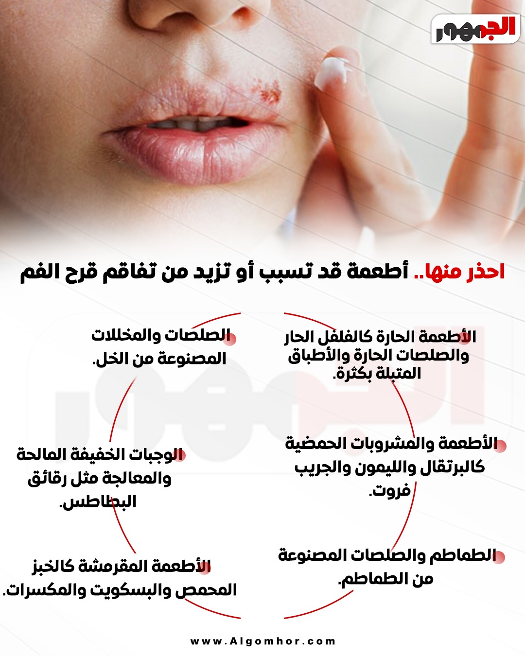 <strong>أطعمة قد تسبب أو تزيد من تفاقم قرح الفم</strong>