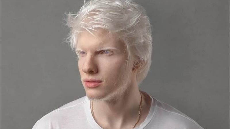 مرض المهق