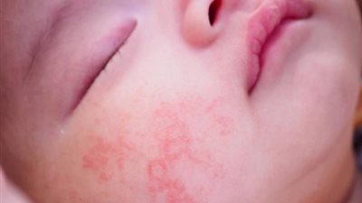 للأمهات.. إليك الأطعمة التي تسبب حساسية الأطفال تعرفي عليها