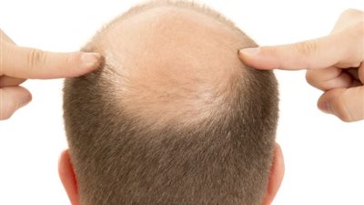 «باستخدام حوافر الحيوانات».. محاولات المصريين القدماء لعلاج الصلع