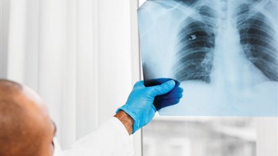 سرطان الرئة، «الصحة» تقدم 4 خطوات للوقاية من الإصابة بالمرض