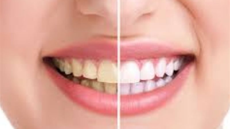 نصائح وعواقب صحة الاسنان