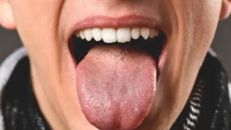 لون اللسان يكشف عن نوع المرض - تعبيرية