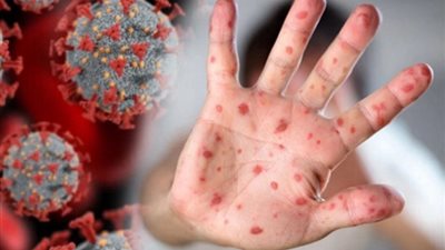 الأمراض تضرب الصين، اكتشاف سلالة فرعية جديدة من جدري القرود في بكين