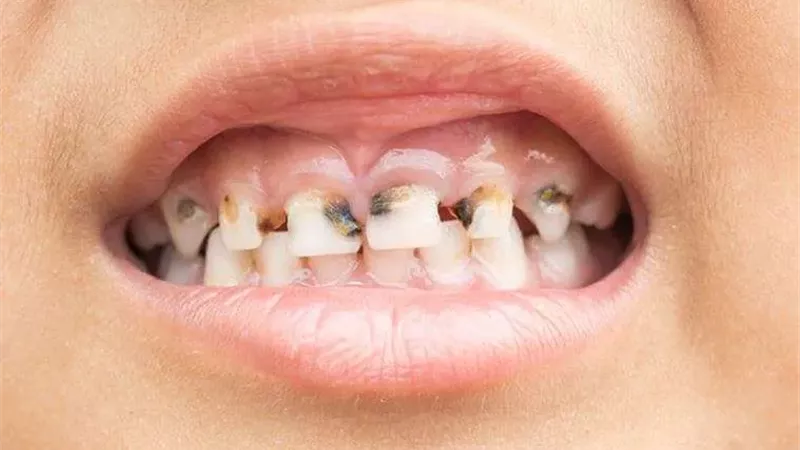 تسوس الأسنان