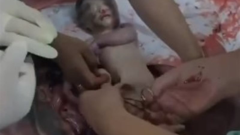 انتشال جنين من بطن أمه بعد استشهادها