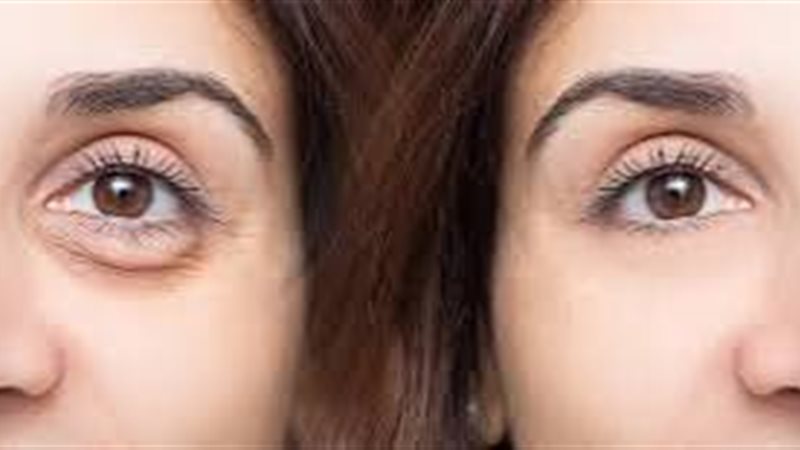 ماسكات لمحو انتفاخ العين 
