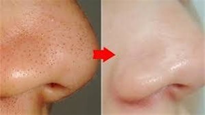 بدون مستحضرات تجميل.. 6 طرق للتخلص من البثور السوداء 