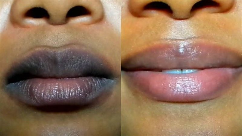 طرق علاج اسمرار الشفاه 