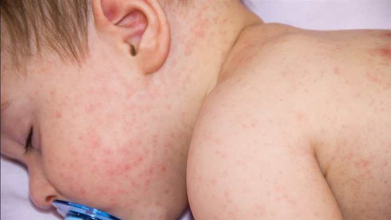 خطوات للتخلص من حمو النيل 