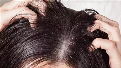 هتودعيها في 4 خطوات … كيفية التخلص من قشرة الشعر بسهولة وفعالية 