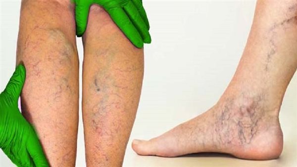بعد إعلان إصابة ترامب به.. ما هو القصور الوريدي المزمن؟