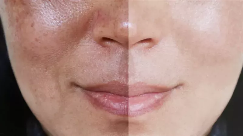 طرق علاج كلف البشرة 