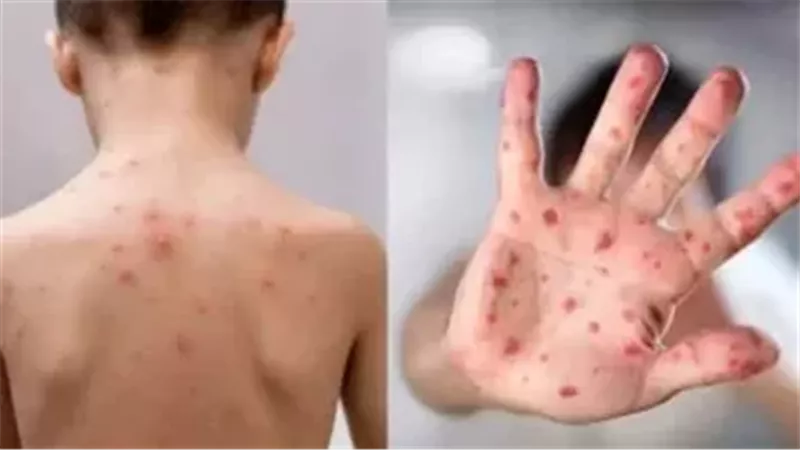  الجديري المائي