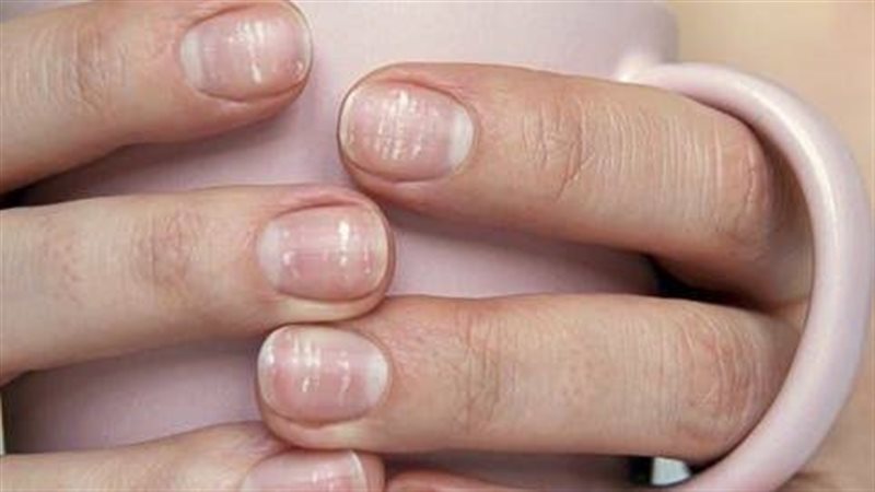 أسباب البقع البيضاء على الأظافر 