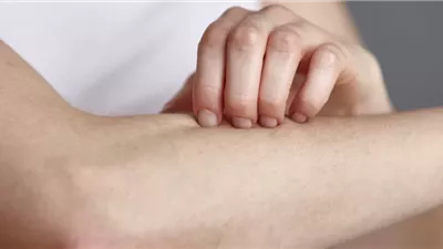 علاج الأكزيما طبيعيًا.. طرق منزلية فعالة لتهدئة الحكة وترطيب البشرة