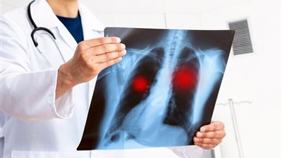 كيف تنقذ «حمية المتوسط» رخيصة الثمن رئتيك من السرطان والموت المبكر؟