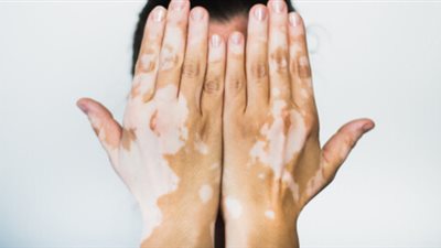 علامات على الجلد قد تكشف أمراضًا خطيرة.. جمال شعبان يوضح